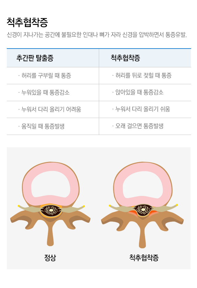 내시경 치료 가능한 척추질환