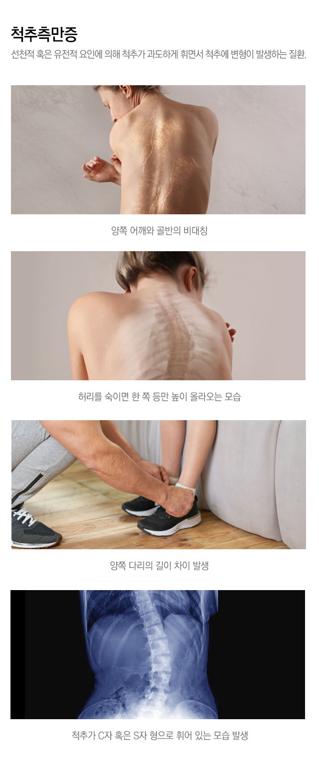 내시경 치료 가능한 척추질환